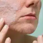 Para Adolescentes 3 Recetas Para Curar El Acne