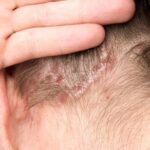 4 Sintomas De Que Sufres Psoriasis Y No Tienes Idea